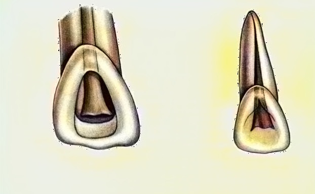 Access Opening in maxillary Central Incisor