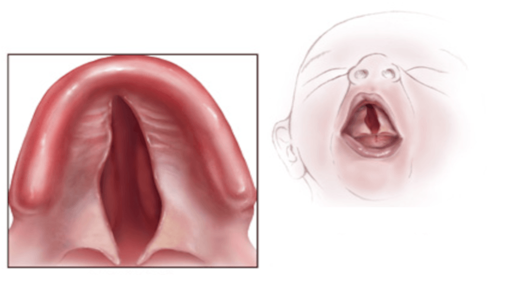 Cleft Palate Types and Management