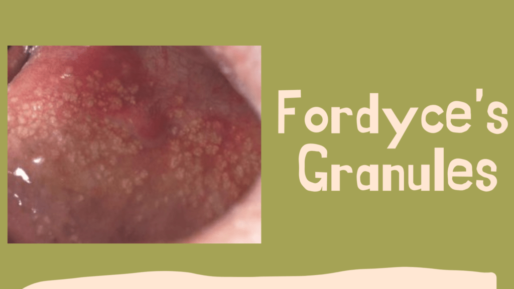 Fordyce's Granules