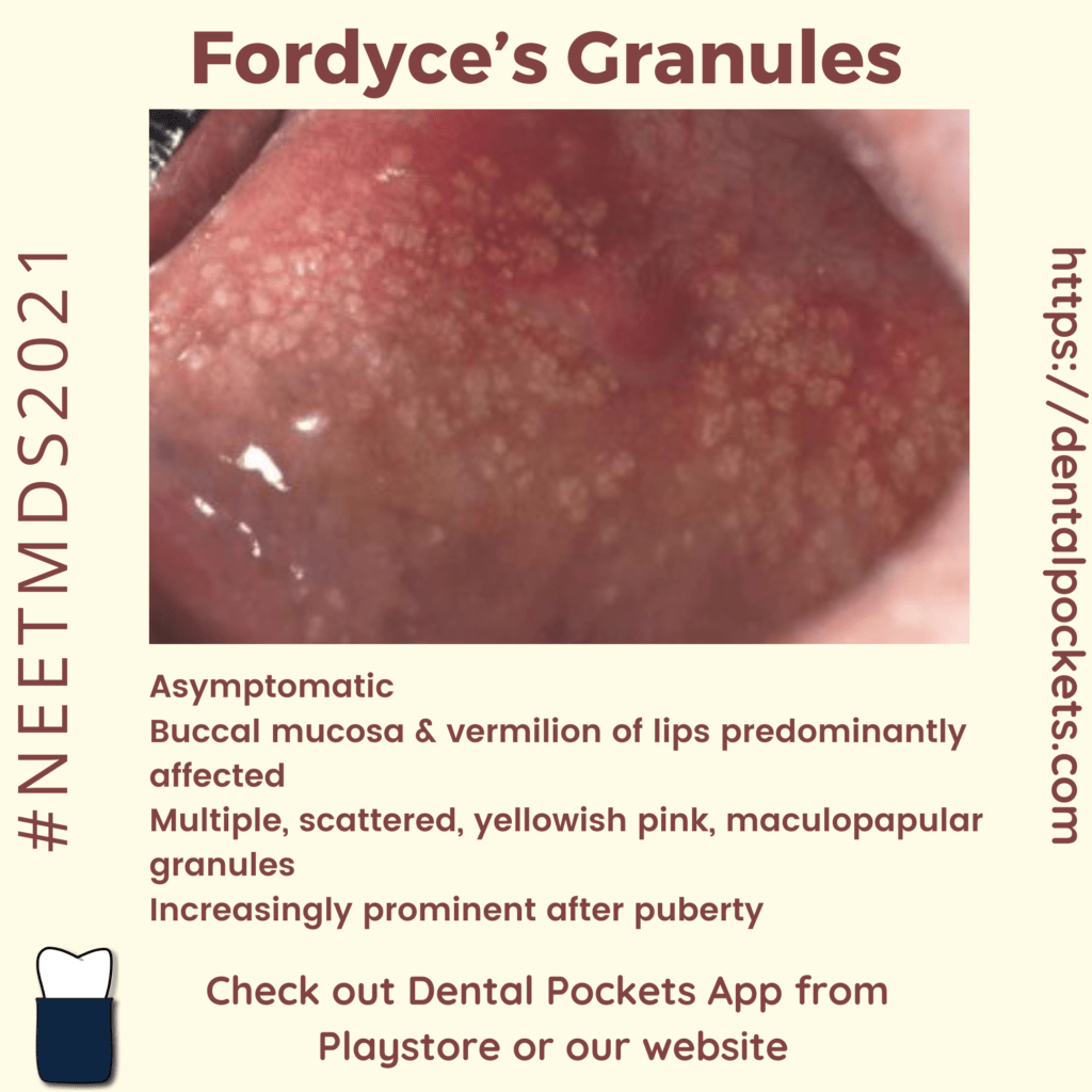 Fordyces Granules Dental Pockets Blog