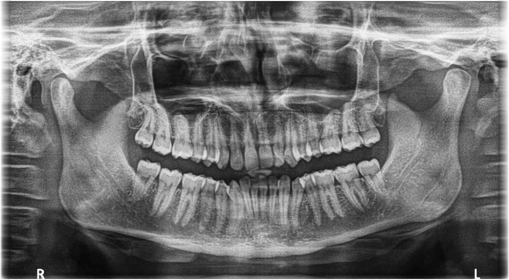 Third Molar OPG